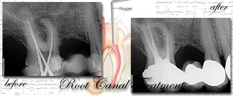 root canal treatment
